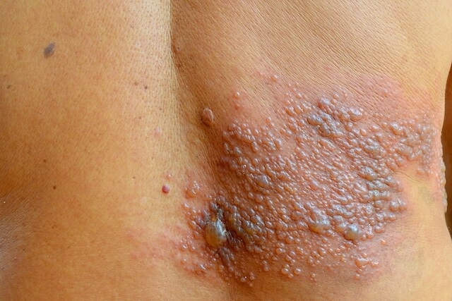 dermatite herpetiforme bolhosa