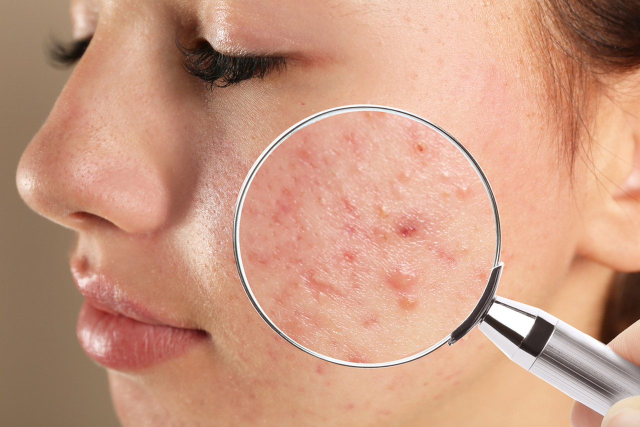 beneficios da vitamina a menina adolescente com acne na pele